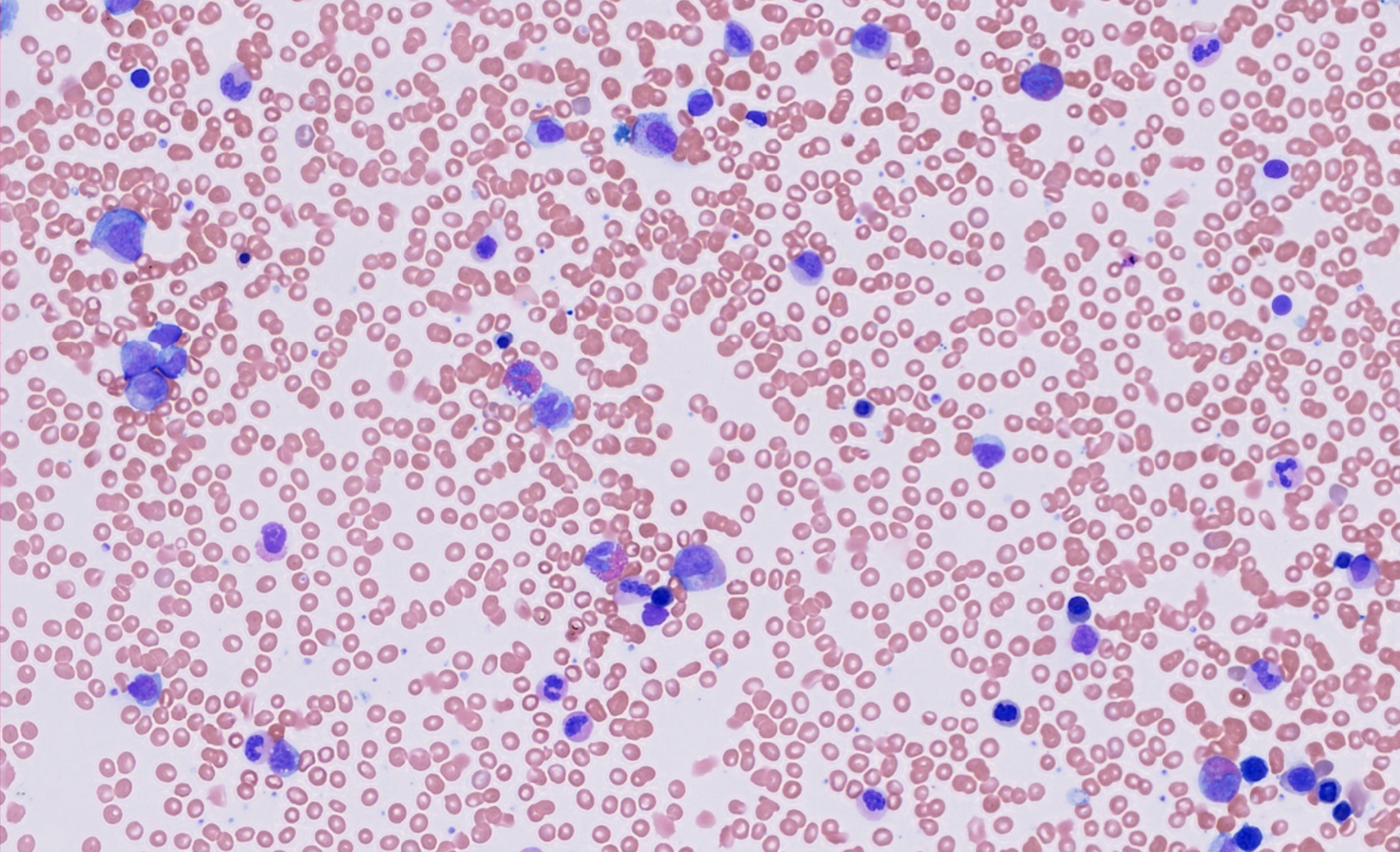 Bone marrow aspirate smear Image