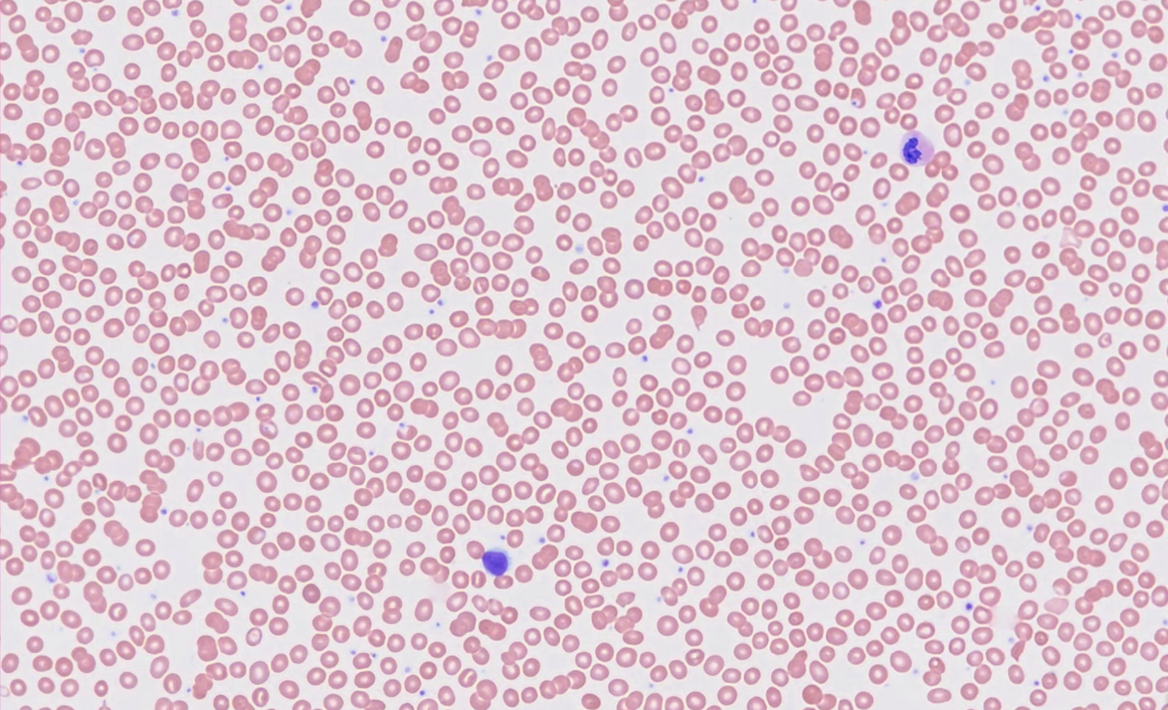 Peripheral smear Image